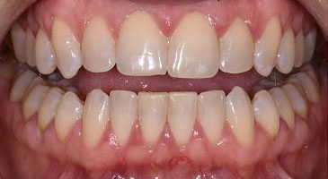 periodontal decontamination