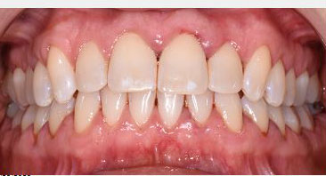 periodontal decontamination