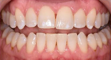 periodontal decontamination