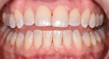 periodontal decontamination