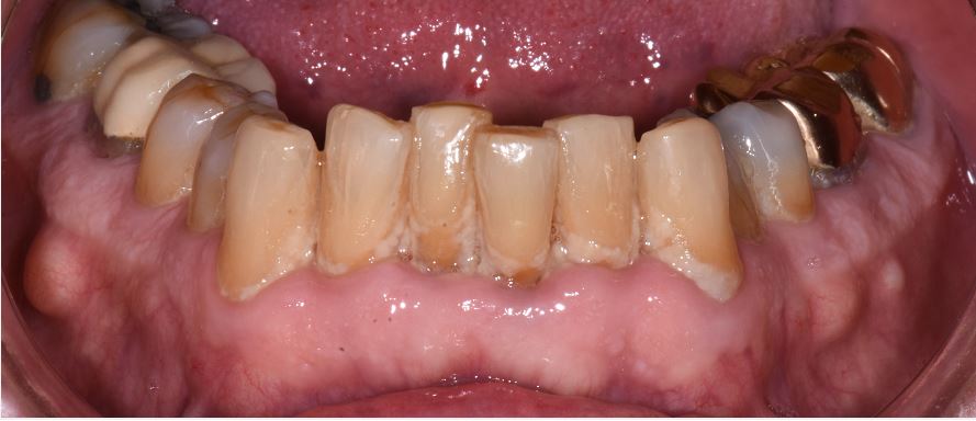 periodontal decontamination