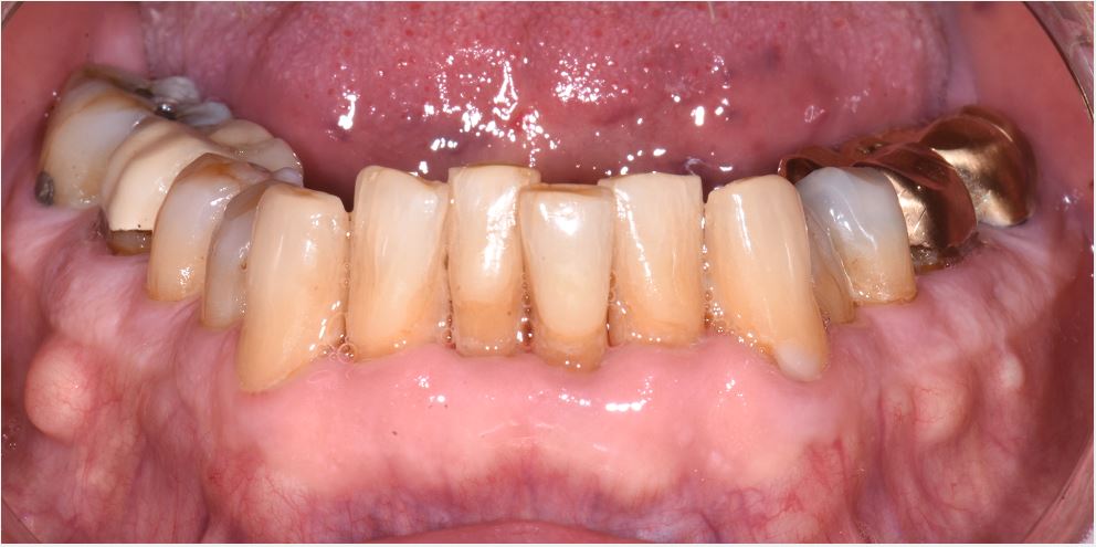 periodontal decontamination
