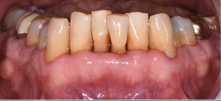 periodontal decontamination