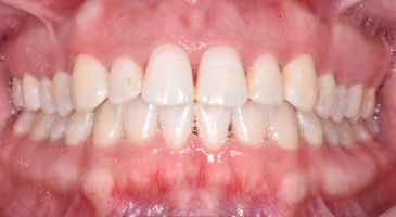 periodontal decontamination
