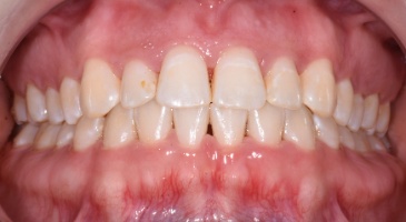 periodontal decontamination