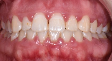 periodontal decontamination