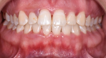 periodontal decontamination